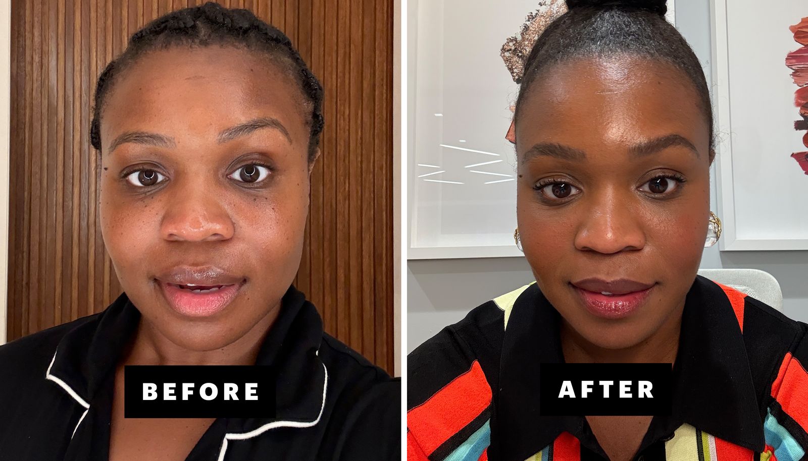 Unboxing the World of Botox: What You Need to Know